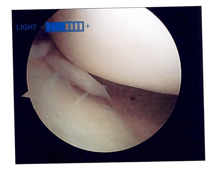 arthroscopy picture#1